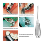 Dźwignia SD-017-009-ZT - 2